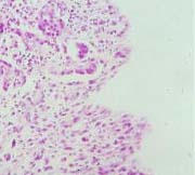 biphasic mesothelioma tissue