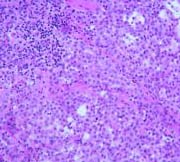 epithelioid mesothelioma tissue