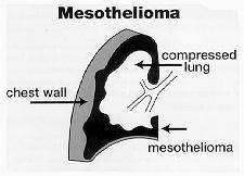 lung with mesothelioma