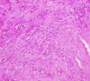 sarcomatoid mesothelioma tissue